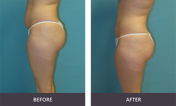 Before & After