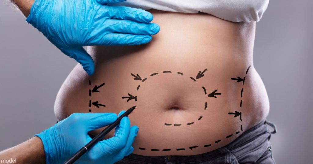 woman with doctor drawing tummy tuck and liposuction lines on her stomach (model)
