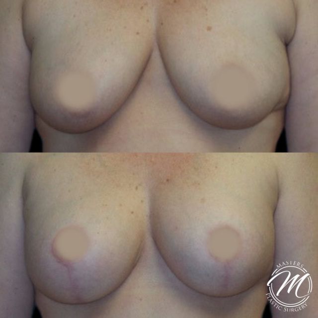 Check out these amazing natural looking results |Breast lift w/ Implant|
A breast lift can dramatically change how you feel about your body.

Call us today to Book an appointment

(405) 849-6354

or click the link in our bio. 

#breastaugmentation #plasticsurgeon #plastics #plasticsurgeonsofinstagram #mastersplaticsurgery