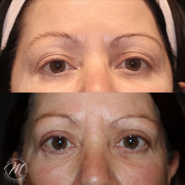 This patient wanted a refreshed and rested look that would shave years off of her appearance. *4 weeks post op

 BLEPHAROPLASTY: commonly called eyelid surgery. 

Call us today to Book an appointment

(405) 849-6354

or click the link in our bio. 

#faceliftsurgery #facelift #blepharoplasty #nicholshills #plasticsurgeon #plastics #plasticsurgeonsofinstagram #mastersplaticsurgery