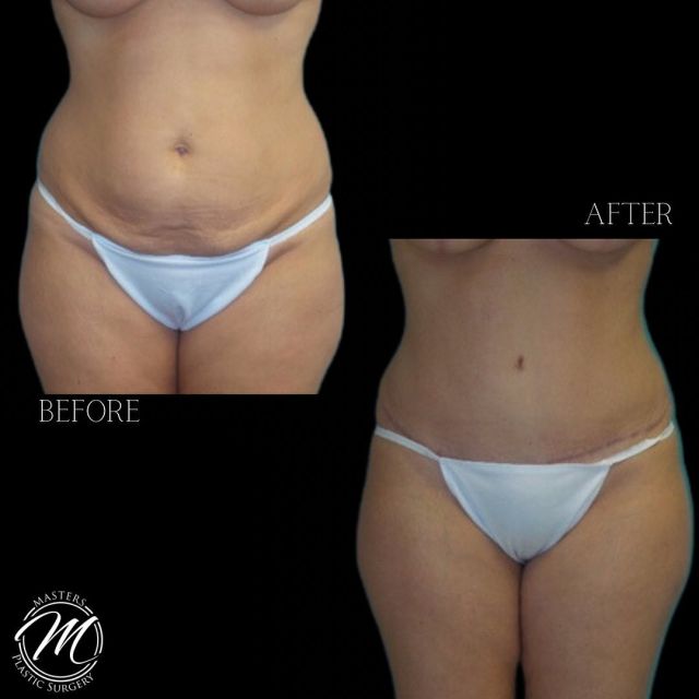 This Tummy tuck w/ LIPO transformation is incredible. Leaving our patient happy & giving her an extra boost of confidence.

*Successful tummy tuck surgery begins during the consultation. 

Call today to schedule a consult!

(405) 849-6354

or click the link in our bio

#tummytuck #lipo #mommymakeover #bodylift #nicholshills #plasticsurgeon #plastics #plasticsurgeonsofinstagram  #mastersplaticsurgery