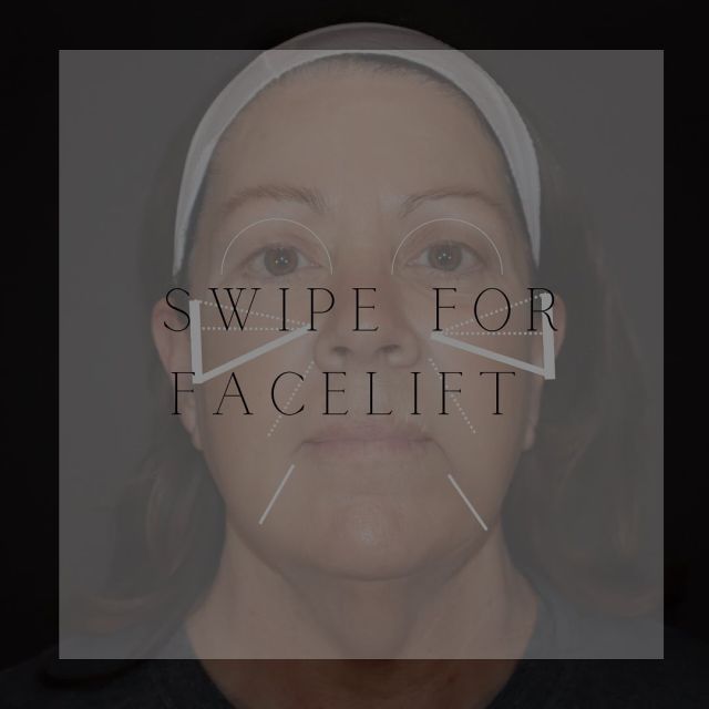 Swipe for results!

4 week post op results are in and this patient is feeling and looking younger with her results!

#faceliftsurgery #facelift #blepharoplasty #nicholshills #plasticsurgeon #plastics #plasticsurgeonsofinstagram #mastersplaticsurgery