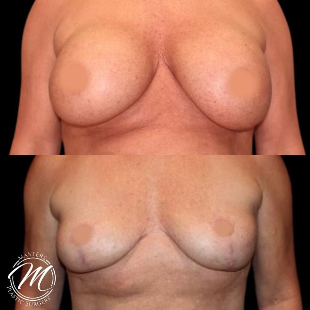 EXPLANT W/ LIFT
There are several reasons women choose this option:
•Changing trends
•Lifestyle changes
•Age
•Complications
•liness
Implant removal combined with a breast lift can restore the breasts to a more youthful position.
You can meet personally with Dr.Masters to find out what the best choice is for you.

Call today to book a consult.

(405) 849-6354

or click the link in our bio.

#explantsurgery #explant #breastaugmentation #plasticsurgeon #plastics #plasticsurgeonsofinstagram #mastersplaticsurgery